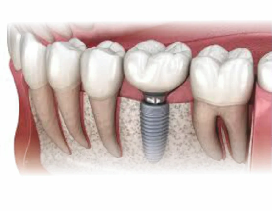 Dental Implants